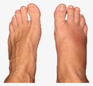 Edema Or Swollen Feet - Stress Fracture Foot #1041656