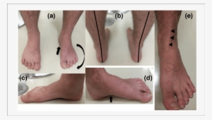 Preoperative Macroscopic Findings - Barefoot #1041990
