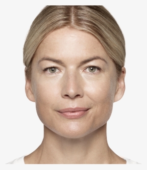 See Where Restylane® Products Can Help Reduce Your - Restylane #1043403