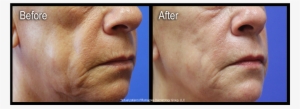 Are Injectable Gels Used To Restore Fullness And Volume - Scar #1043989