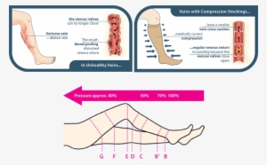 Traditionally, Patients With Varicose Veins Were Recommended - Conservative Treatment Of Varicose Veins #1052160