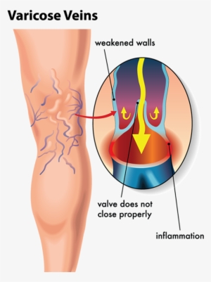 By Unsightly Veins Are Delighted With The Results They - Varicose Veins Diagram #1052636