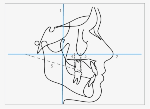 Lines Demarcated On The Lateral Teleradiograph - Line Art #1062441