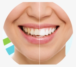 Teeth Whitening - Restorations Teeth #1074079