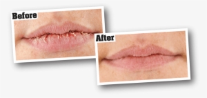 For Best Results - O Keefe Lip Repair #1109457