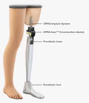 Popular Images - Amputation Prosthesis #1130658