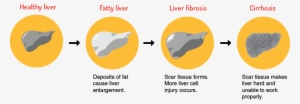 Causes - Fatty Liver Disease #1152844