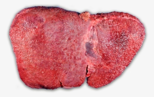 The Progression Of Liver Disease - Wilson Disease #1153410