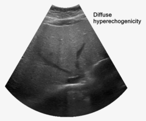 Fatty Liver - Miniskirt #1153611