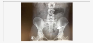 Abdominal Radiograph Of Pelvis With Arrow Pointing - X-ray #1173584