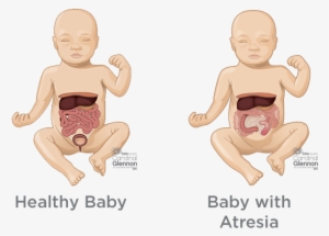 How Is It Managed And Treated During Pregnancy - Congenital Diaphragmatic Hernia #1206566