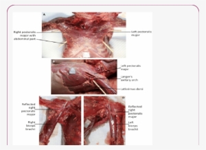 Anterior View Of The Chest Of Female 33 Week Old Fetus - Red Meat #1207285 Anterior View Of The Chest Of Female 33 Week Old Fetus - Red Meat #1207285