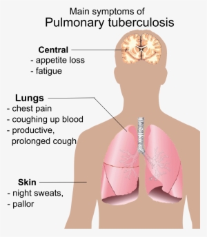 Pulmonary Tuberculosis Symptoms - Symptoms Of Aids - Free Transparent ...