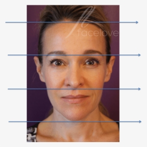 Lower Face Rejuvenation At Facelove - Can Cheek Filler Lift Jowls #1274409