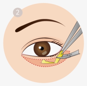 Royalty Free Stock Fresh Plastic Surgery Removes Saggy - Royalty-free #1282606