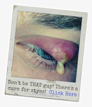 Eye Stye #1282893