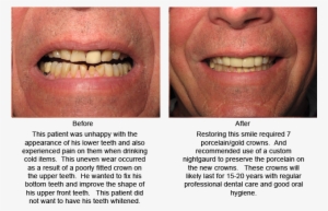 This Patient Desired A Brighter Smile In Minimum Time - Aggression #1309383 This Patient Desired A Brighter Smile In Minimum Time - Aggression #1309383
