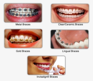 Clear Aligners #1309427