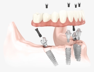 All On 4 Implants, Zygomatic Implants & Implant Dentures - All On 4 Implants #1309531