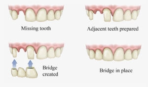 Service Img Bridge - Dental Bridge #1309594