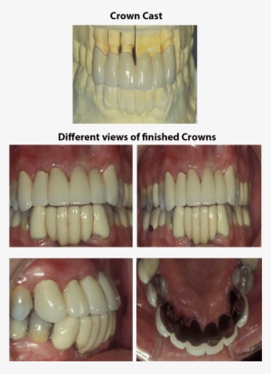 This Case Shows The Finished Bridge Of One Of Our Patients - Washington, D.c. #1310033