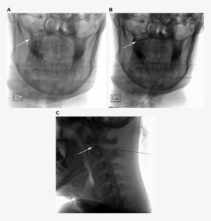 Needle Position And Contrast Filling Of The C1 2 Joint - Cervical 0 C1 Facet Joint Injection #1319293