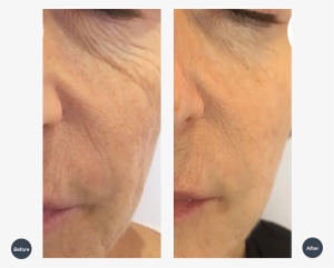 Treatment Of Skin Texture And Rejuvenation - Scar #1352331