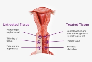 Vaginal Health Is An Important Part Of Your Overall - Vulvovaginal Atrophy #1398827