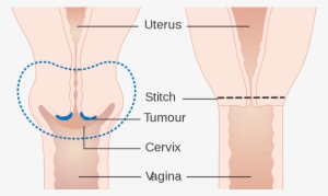 Removal Of Cervix Surgery #1399027