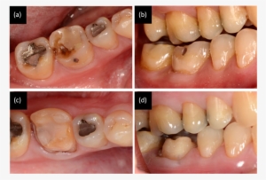 The Lower First Molar Has A Defective Restoration And - Macro Photography #1447401