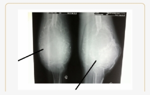 Ap And (b) Lateral Radiographs Of The Left Knee Joint - Osteolytic Lesion #1570950 Ap And (b) Lateral Radiographs Of The Left Knee Joint - Osteolytic Lesion #1570950