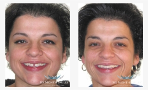 Prevnext - 6 Month Smiles Gaps #1573516