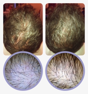 Androgenic Alopecia A Prp® Injections Are Simple And - Prp Hair Before And After #1580531