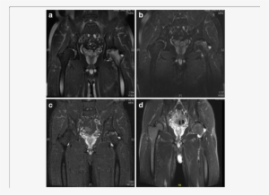 Mri Of A M - Common Fig #1663006