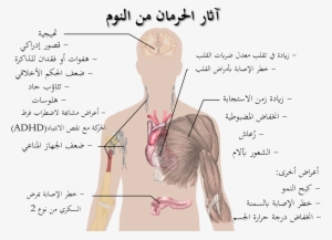 Effects Of Sleep Deprivation-ar - Healthy Lifestyle Is Important #174970
