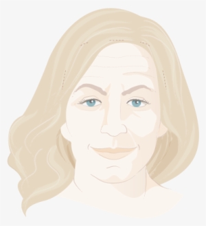 Graphic Showing Woman's Face Before Brow Lift - Visual Arts #1740824