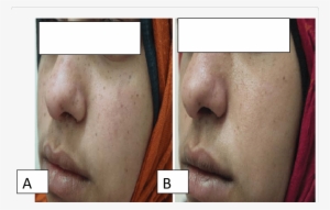 Female Patients 27 Years Old With Freckle Treated With - Q Switch Yag Laser For Freckles #188333