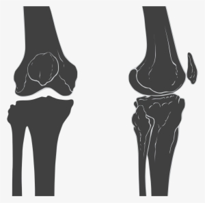 Open - Knee Skeleton #1832775