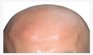 Baldhead - Hair Loss #1838632