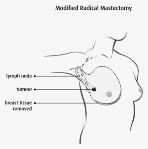 Diagram Of A Modified Radical Mastectomy - Muscle Between Boob And Armpit #1845034