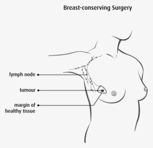 Diagram Of Breast Conserving Surgery - Surgery In Breast Cancer #1845082