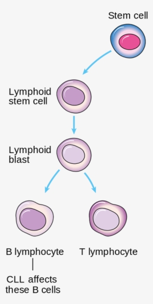 Picture - Acute Lymphoblastic Leukemia Formation - Free Transparent PNG ...