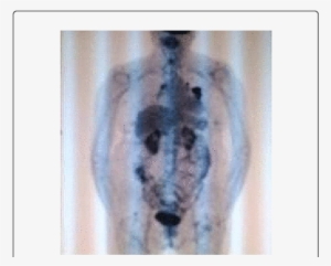 Follow Up Pet/ct Images In Transaxial And Multiple - Painting #2009436