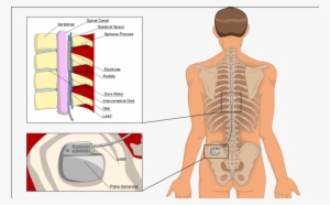 Spinal Cord Stimulation - Spinal Stimulation Pain #2050028