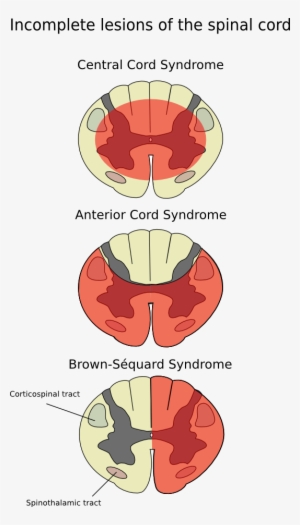 File - Cord-en - Anterior Spinal Syndrome #2050073