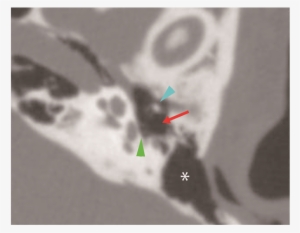 High-resolution Computed Tomography Revealed An Ambiguous - Computed Tomography #2064225