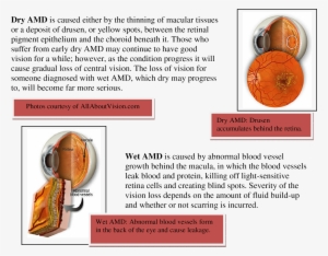 Eyeball Chart - Age Related Macular Degeneration #2130177