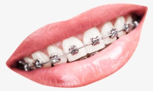 Teeth With Braces Png Transparent Image - Teeth Braces Png #2148076