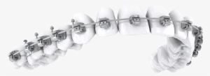Why Braces - Orthodontic Brackets Png #2148106