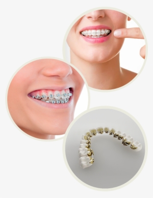 International Dental Center In Puerto Vallarta - Elastice Albe Aparat Dentar #2148173